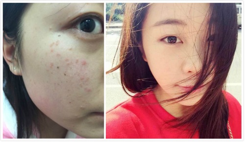 扁平疣最好治疗方法梁澜(祛疣不留印)-医药卫生