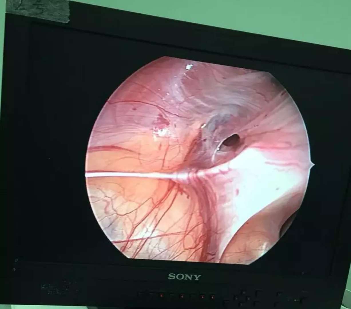 濮阳市人民医院成功开展小儿单孔腹腔镜技术
