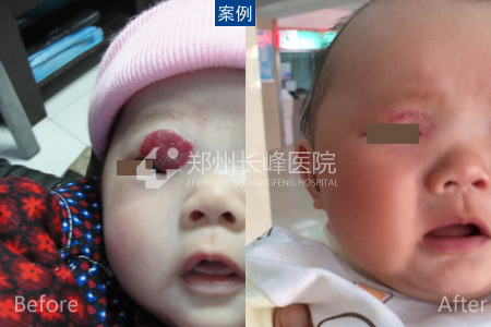 色素瘤长在哪 201808081045167683.jpg