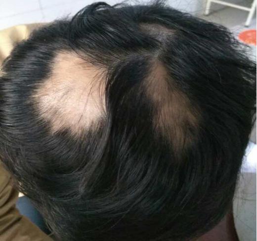 中医郭荣年大夫专业治疗脱发、斑秃、全秃及各