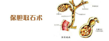 保胆取石教授胡海空降郑州市十院 使您术后依