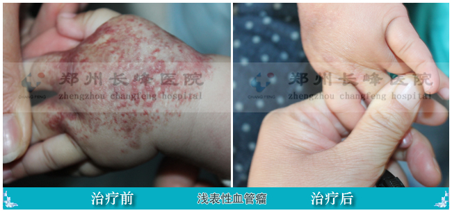 有什么药可以治血管瘤 201901090933542897.jpg