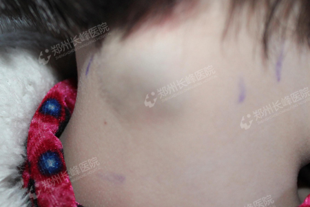 请别叫我海绵宝宝,我是血管瘤 !