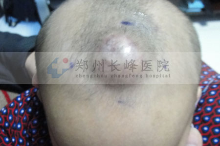 血管瘤图片是什么原理_血管瘤是什么样子的图(2)