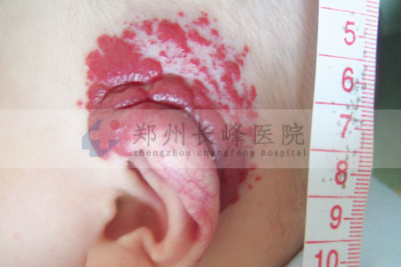 血管瘤图片是什么原理_血管瘤是什么样子的图(2)
